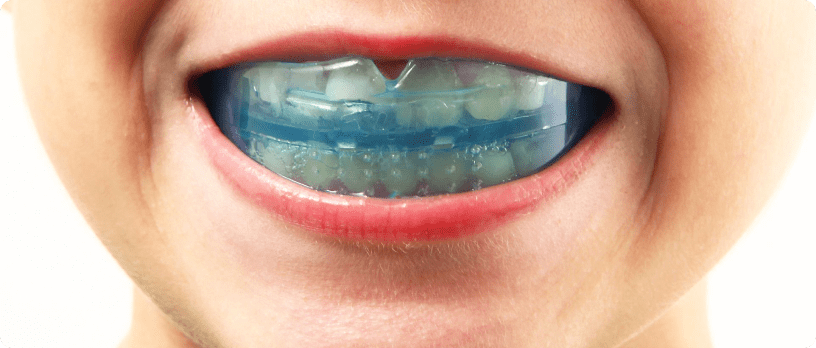 Les protèges des dents